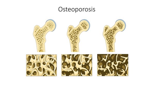 L'ostéoporose : Comprendre cette maladie silencieuse et ses solutions efficaces